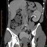 Unilateral renal agenesis