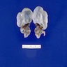 Multiple cysts of various sizes