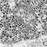 Tumor cells with premelanosomes
