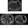 Isodense mass in the renal medulla