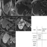 Hyperintensity on T2 weighted image