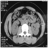 Noncontrast axial CT with 2.5 cm mass