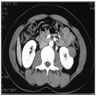 Postcontrast axial CT without evidence of enhancement