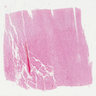 Chromophobe RCC, classic