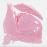 Chromophobe RCC, eosinophilic