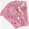 Morphologic diversity of chromophobe RCC