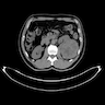 Left sided clear cell renal cell carcinoma (CT scan)