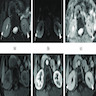 MRI of renal adenomatosis