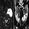 MRI showing laryngeal cyst