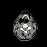 Right sided combined laryngocele identified by CT scan of the larynx