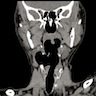 Right sided combined laryngocele identified by CT scan of the larynx