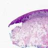 Mucosal lichen planus