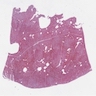 Epithelioid cells, vessels, hemorrhage