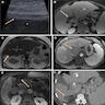 MRI of cirrhotic liver