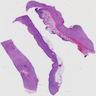 Simple biliary cyst of liver