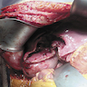 Intraoperative view of the ruptured cyst