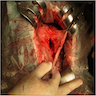 Intraoperative view of perforated lesion of hepatic cyst