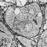 Endothelial cells, solid nests