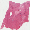 Liver, Focal Nodular Hyperplasia