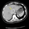 Liver CT