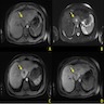 Liver MRI