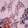 Benign hepatocytes in clusters