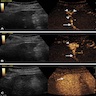 Liver ultrasound