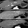 Liver CT