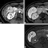 Liver MRI