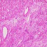 Scar with ductular reaction