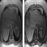 HA-H MRI
