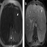 HA-B MRI