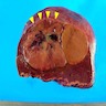 Malignant transformation