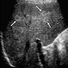 Atoll lesion on ultrasound