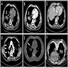 Lobulated mass in right lower lobe of lung