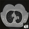 Solitary, noncalcified nodule in left lower lobe