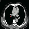 Preoperative CT of pulmonary HCCC