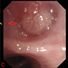 Intrabronchial protrusion of mass