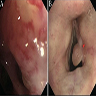 Bronchoscopy of pulmonary HCCC and SCC