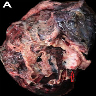 Solid, white and well demarcated lung mass