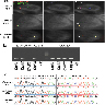 Detection of <i>EWSR1::ATF1</i>