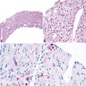 (A) Core needle biopsy shows neoplastic cells in nested and insular pattern surrounding numerous thinned wall sinusoid-like vessels<br>(B) intranuclear cytoplasmic invaginations<br>(C) HMB45+ staining