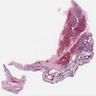 Cystic pleuropulmonary blastoma
