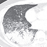 Adenocarcinoma on axial CT