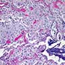 Transbronchial lung biopsy with adenocarcinoma and squamous cell carcinoma