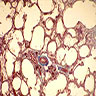 Large alveoli