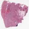 Giant cell carcinoma - Rosai collection