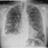 Malignant melanoma<br>shows pulmonary<br>nodules
