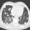 Multiple round nodules and masses in both lungs