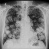 Cannonball lung metastases in patient with colon cancer